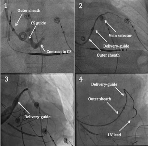 lv lead placement techniques|lv lead placement for crt.